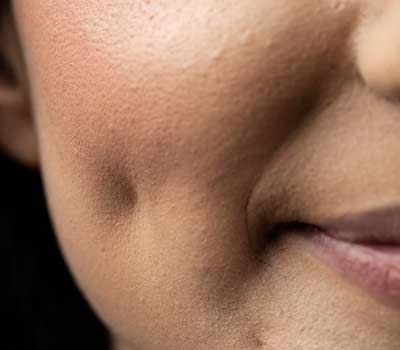 Cheek Dimples Creation - Dr Amit Verma